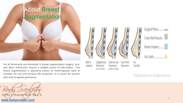 augmentation breast chicago pic Augmentation breast chicago pic